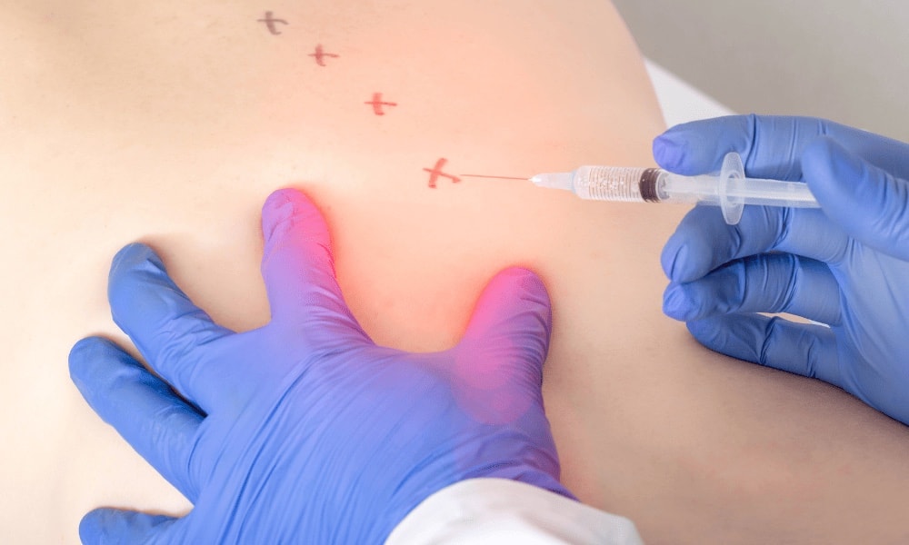 Mãos com luvas azuis pressionando a pele das costas marcada com Xs vermelhos enquanto uma seringa aplica injeção em um ponto demarcado.