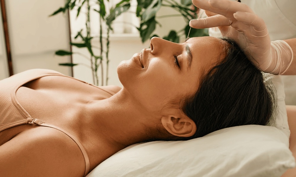 Mulher deitada recebendo acupuntura facial, com agulha fina aplicada na testa por mãos com luvas.