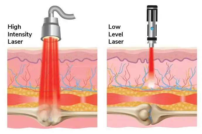 laser alta intensidade