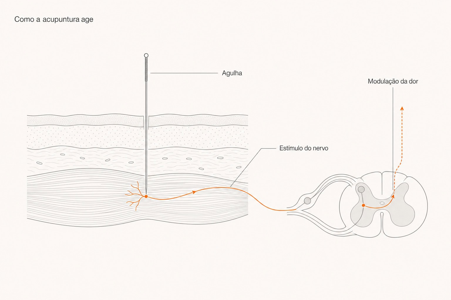 Diagrama: a agulha de acupuntura estimula o nervo e o corpo reduz o sinal de dor na medula e no cérebro.