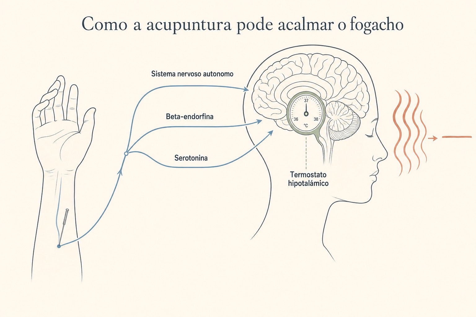 Ilustração editorial do mecanismo: agulha de acupuntura no antebraço envia sinais que, por três vias (sistema nervoso autônomo, beta-endorfina e serotonina), estabilizam o termostato hipotalâmico e aliviam o fogacho