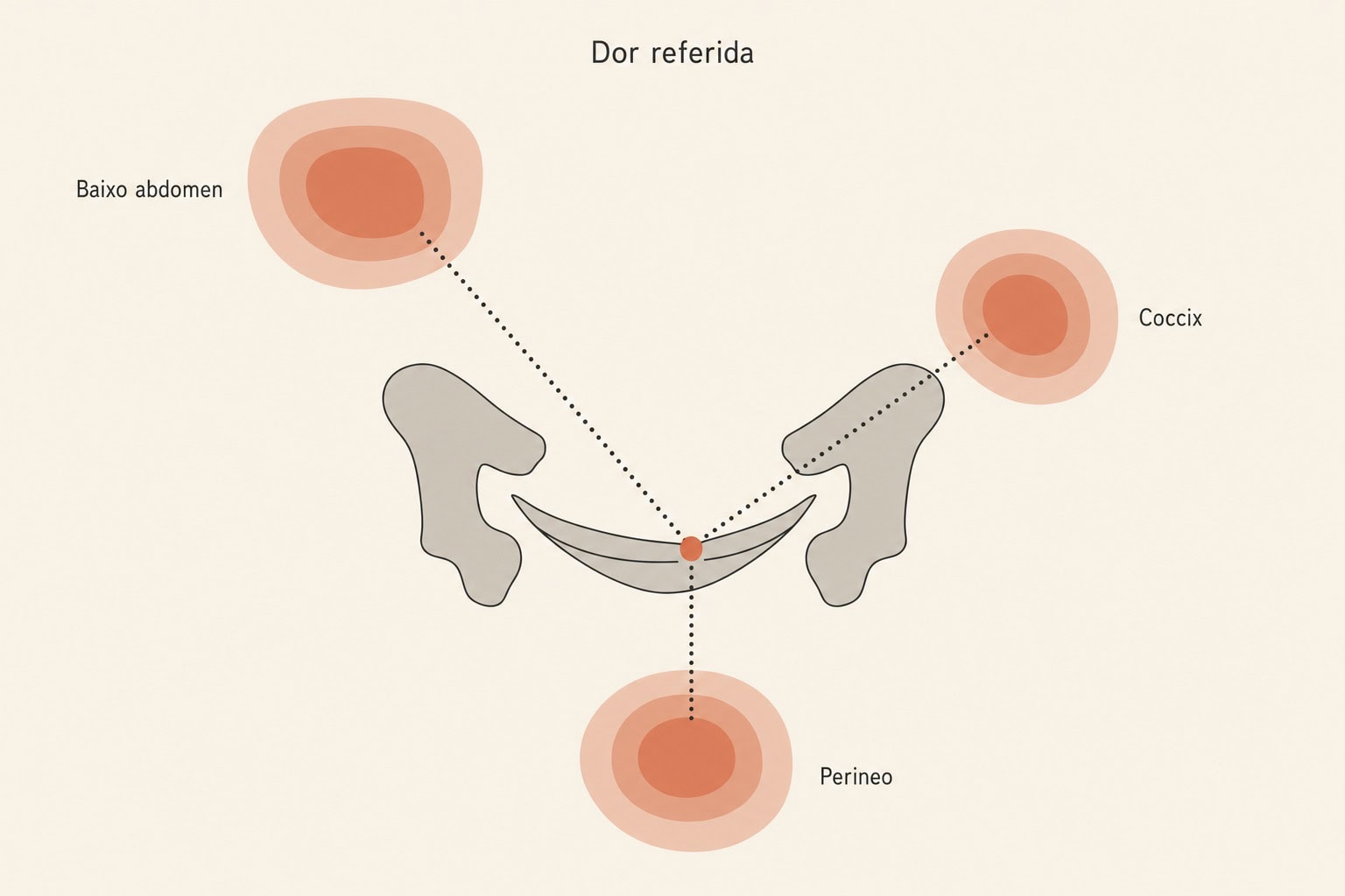 Diagrama de dor referida a partir de um ponto-gatilho no assoalho pélvico, com zonas de dor projetadas para o baixo abdômen, o cóccix e o períneo.