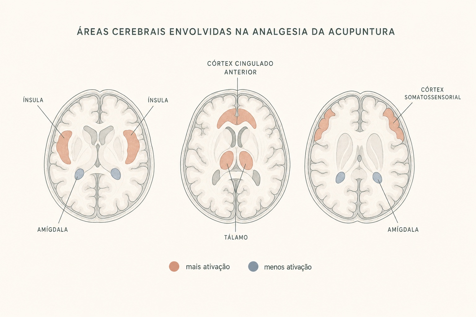Ilustração de três cortes axiais do cérebro com as áreas envolvidas na analgesia da acupuntura: ínsula, córtex cingulado anterior, tálamo e córtex somatossensorial em destaque, e amígdala com menor ativação.