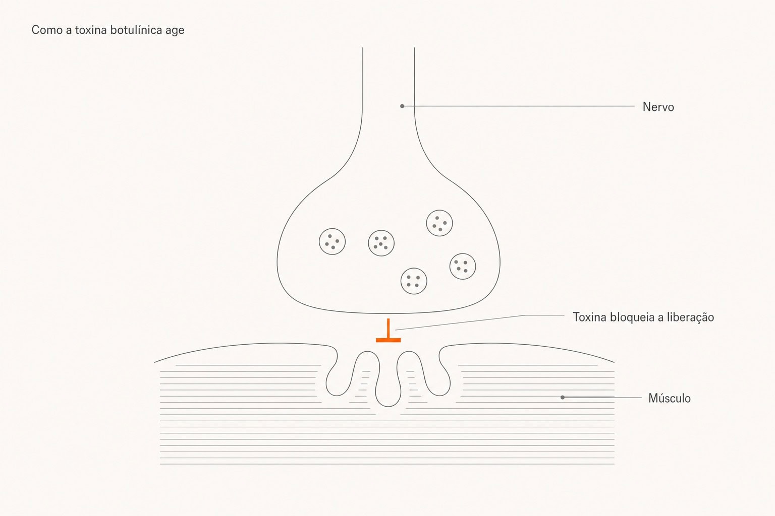 Diagrama da junção neuromuscular: a toxina botulínica bloqueia a liberação do neurotransmissor entre o nervo e o músculo.