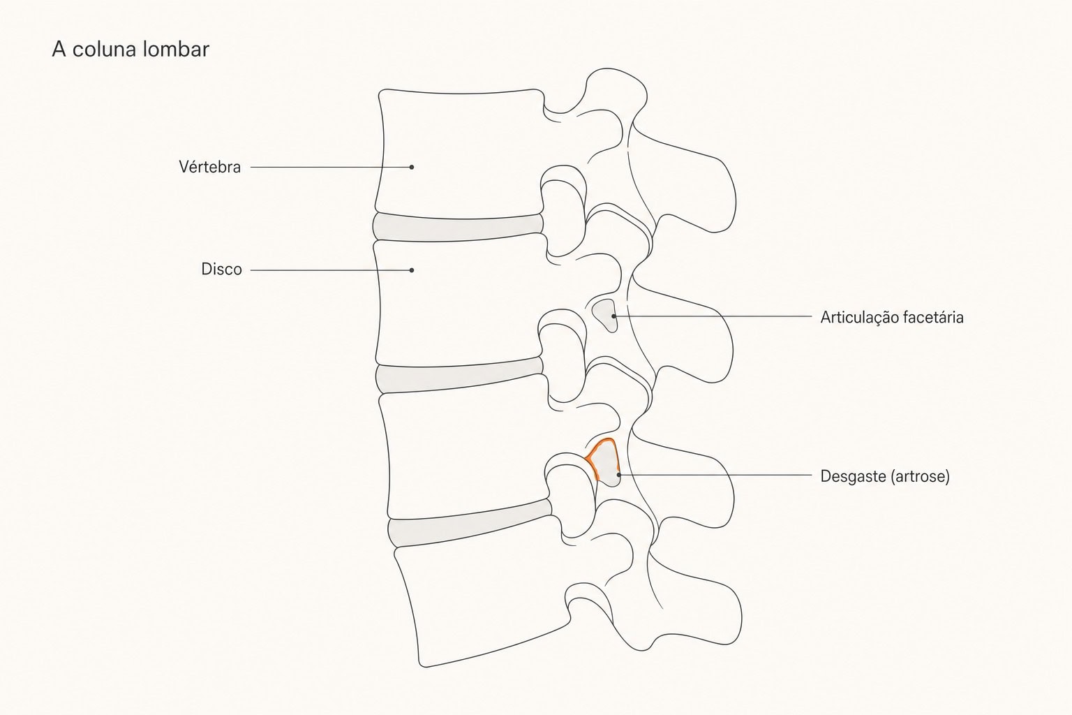 Diagrama da coluna lombar: vértebras, discos e articulações facetárias com desgaste destacado.