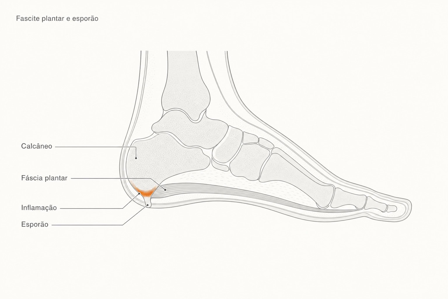 Ilustração lateral do pé em traço com o calcâneo, a fáscia plantar e o esporão na inserção da fáscia, e a inflamação marcada nesse ponto.