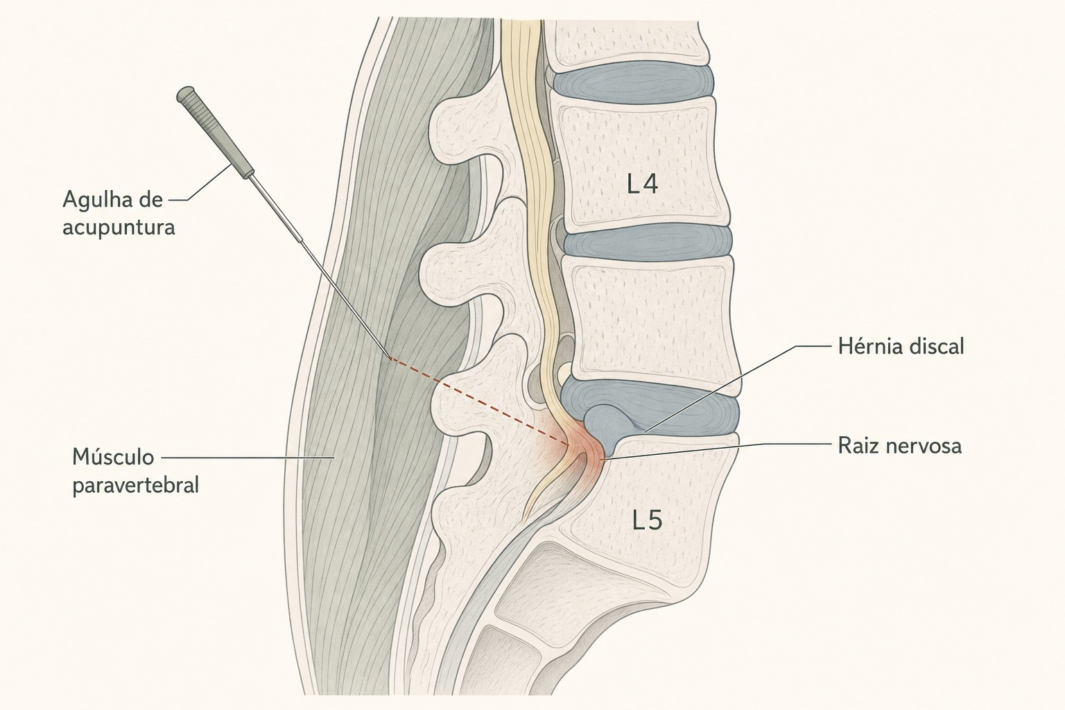 Ilustração em quatro estágios do disco intervertebral: degeneração, protusa, extrusa e sequestrada, ao lado de uma vértebra com hernia em destaque