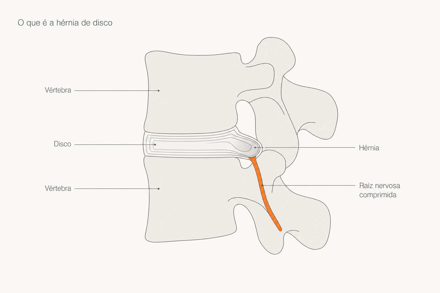 Diagrama: o disco intervertebral se desloca e comprime a raiz nervosa (hérnia de disco).