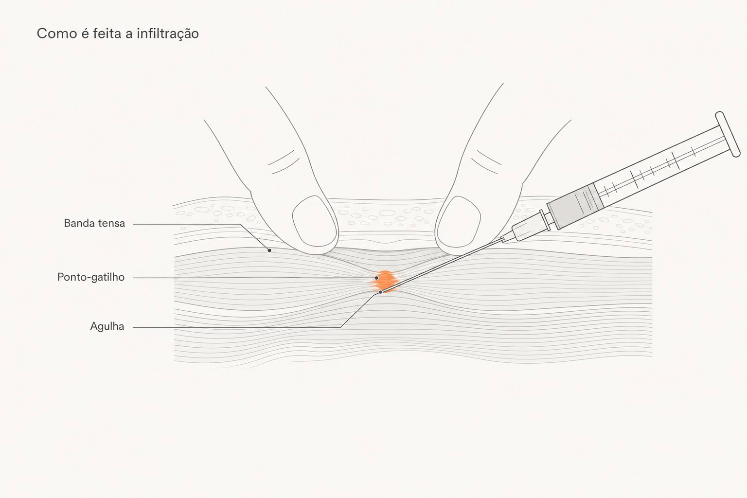 Diagrama: os dedos fixam a banda tensa do músculo e a agulha atinge o ponto-gatilho durante a infiltração.