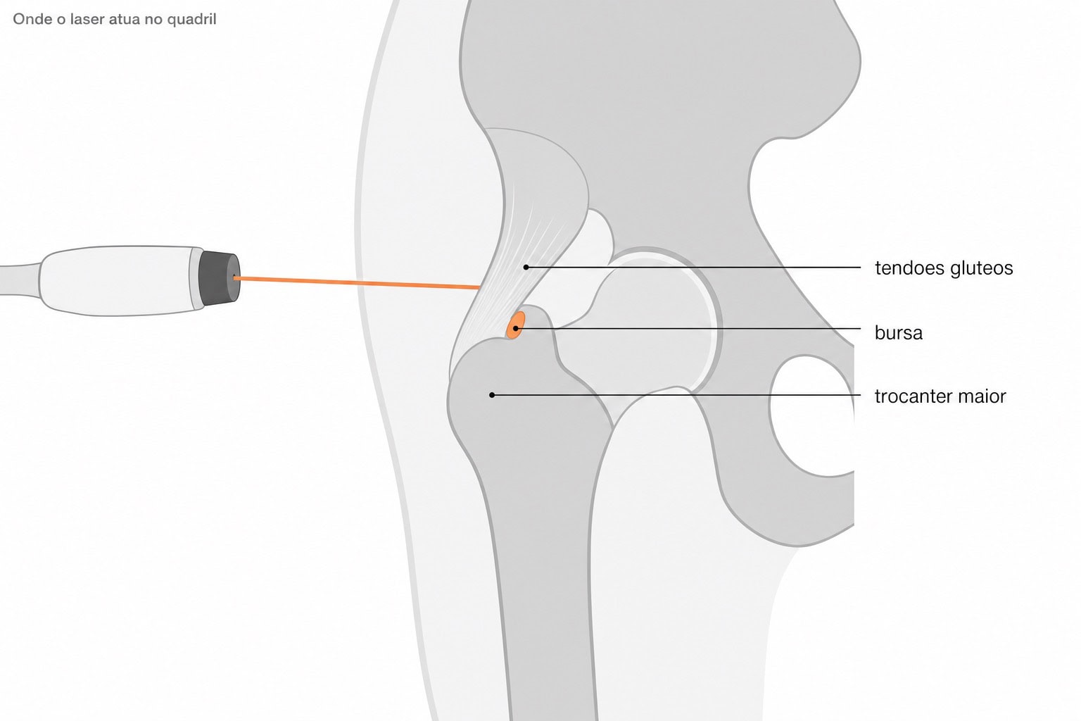 Diagrama do quadril com o feixe do laser de alta intensidade aplicado sobre o trocânter e a inserção dos tendões glúteos.