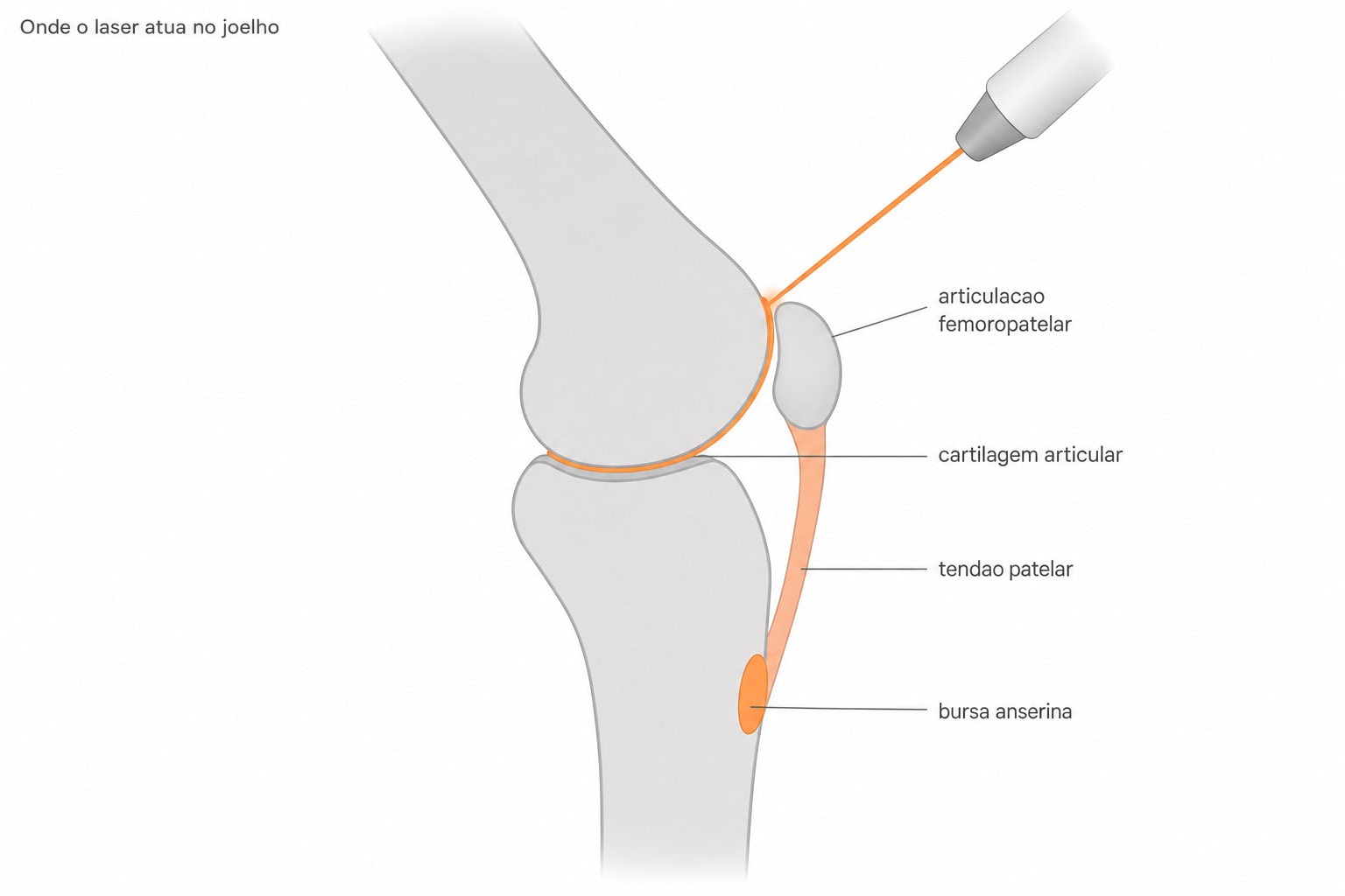 Diagrama do joelho com um feixe de laser apontando para as estruturas tratadas: cartilagem da artrose, tendão patelar, bursa anserina e região femoropatelar.