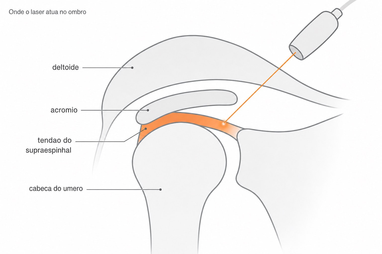 Ombro de perfil com um feixe de laser sobre a borda do acrômio alcançando o tendão do supraespinhal sob o deltoide, estruturas rotuladas