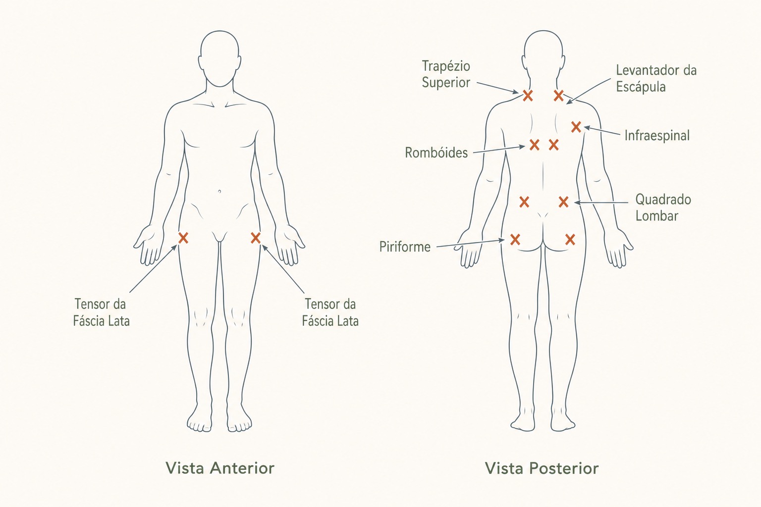 Mapa da musculatura das costas e do pescoço com pontos-gatilho marcados no trapézio, levantador da escápula e romboides