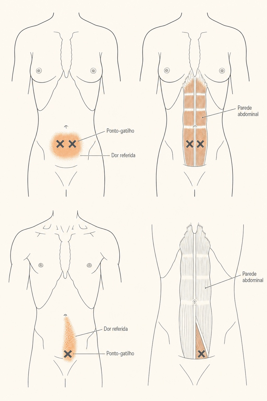Dor na parede abdominal: pontos-gatilho e dor visceral 2 Diagrama da parede abdominal com pontos-gatilho (X) e a dor referida no abdome e nas costas.