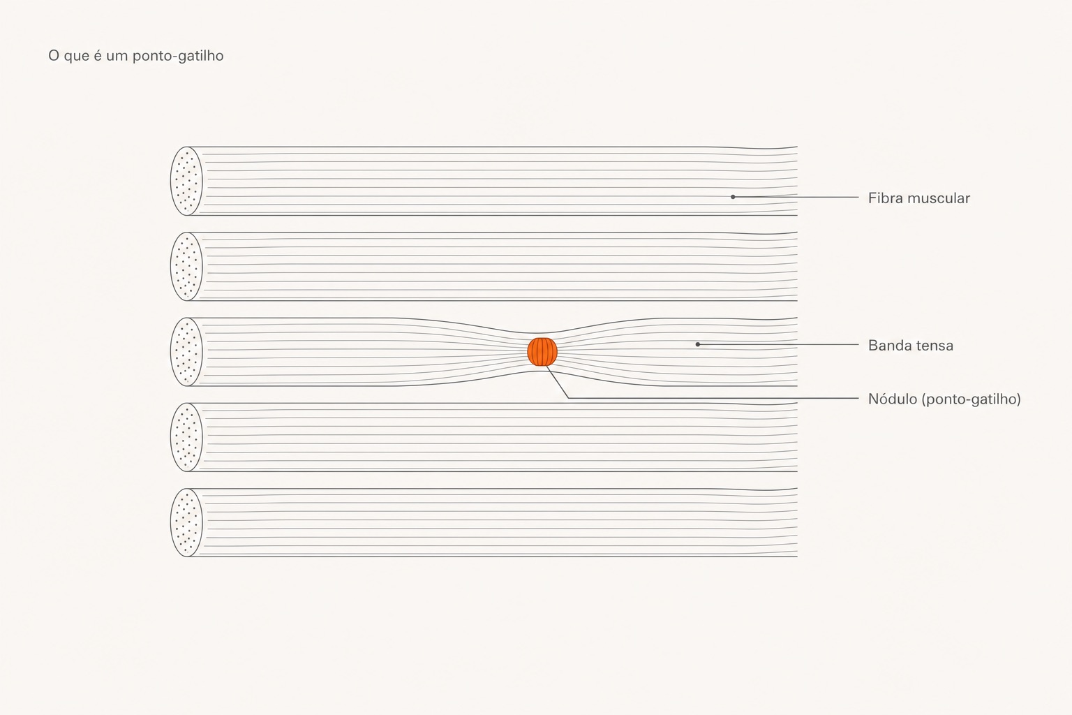 Diagrama de fibras musculares com uma banda tensa e o nódulo contraído (ponto-gatilho).