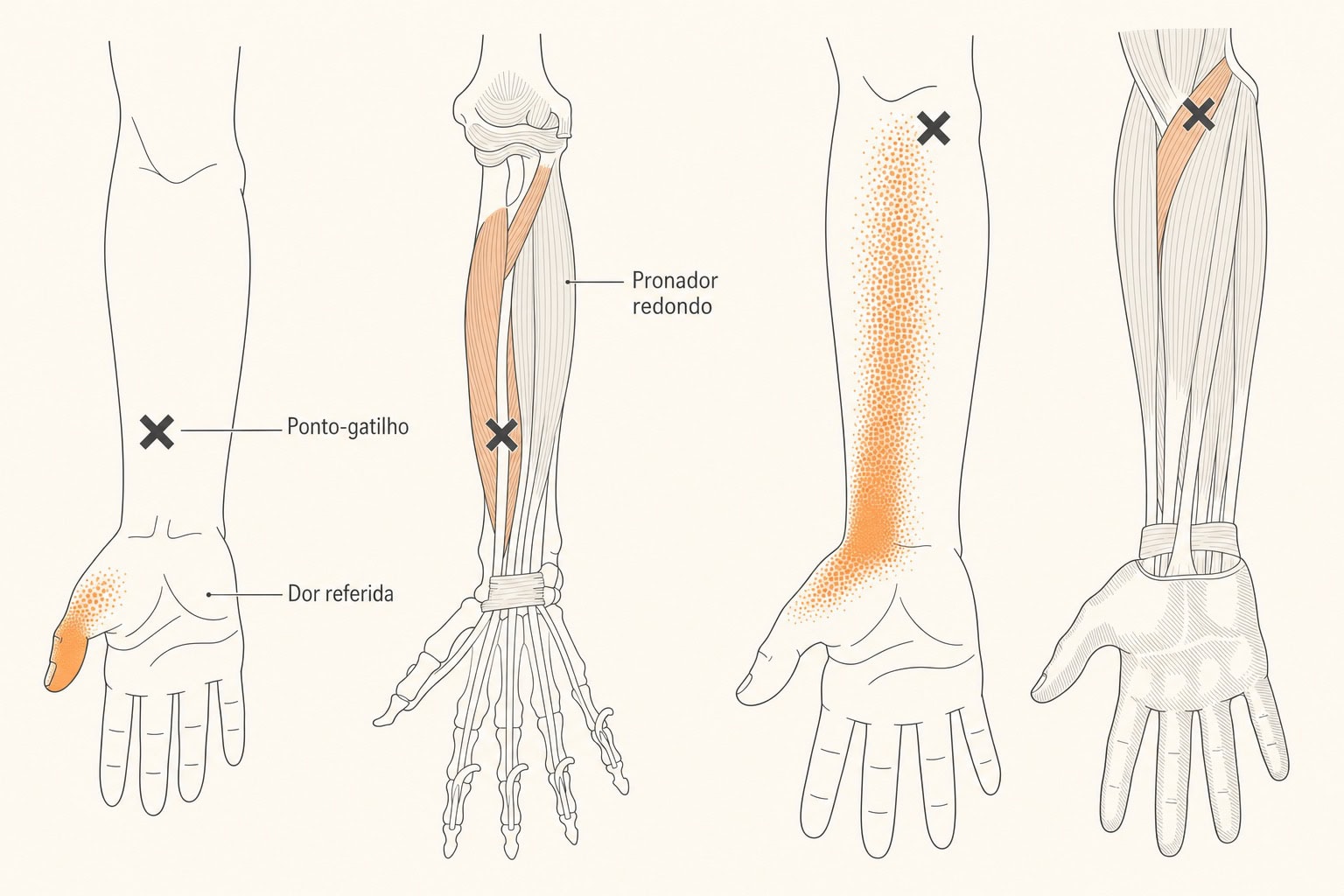 Diagrama do músculo pronador redondo com ponto-gatilho (X) e a dor referida na face palmar do antebraço, punho e polegar.