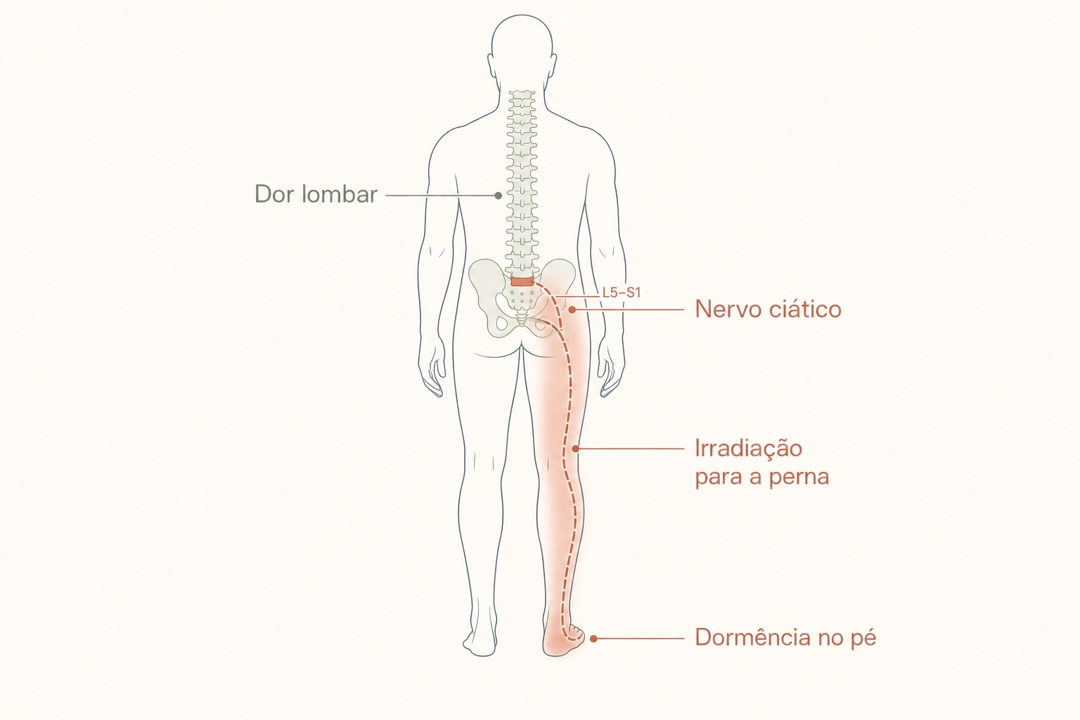 Cinco silhuetas de costas com áreas em vermelho mostrando a irradiação da dor conforme a raiz nervosa de L1 a L5