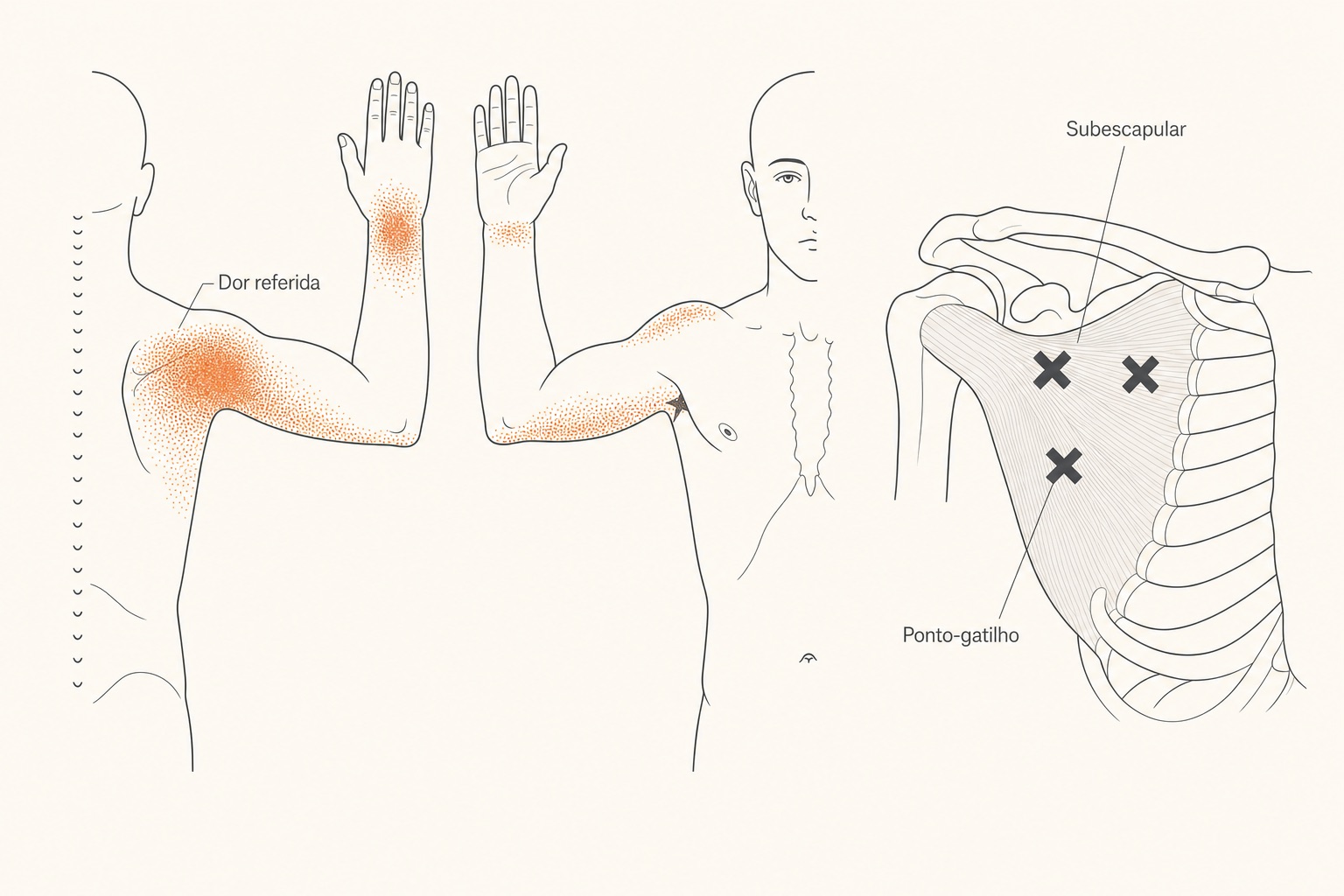 Diagrama do músculo subescapular com pontos-gatilho (X) e a dor referida no ombro posterior e a faixa característica no punho.