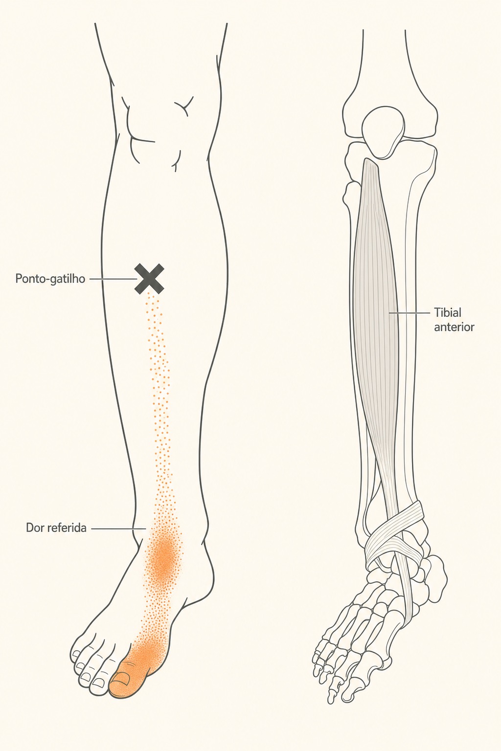 Diagrama do músculo tibial anterior com ponto-gatilho (X) e a dor referida na frente da perna, no tornozelo e no hálux.