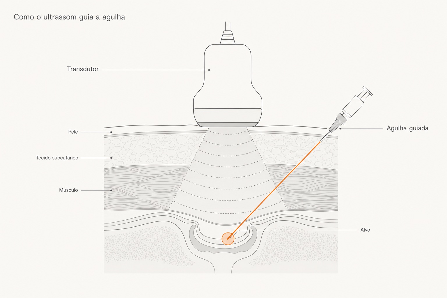 Diagrama: o transdutor de ultrassom mostra o trajeto em tempo real e a agulha chega com precisão ao alvo profundo.