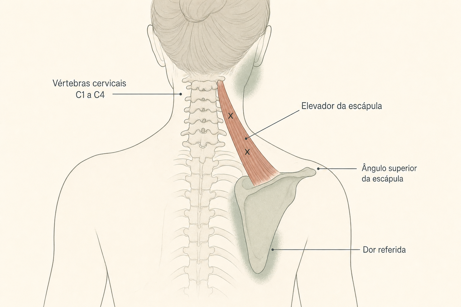 Músculo elevador da escápula: trajeto das vértebras cervicais ao ângulo superior da escápula, com pontos-gatilho e dor referida no ângulo do pescoço