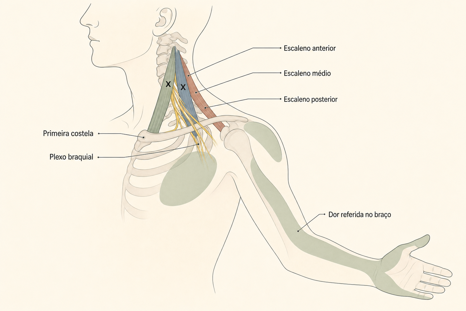 Músculos escalenos anterior, médio e posterior com o plexo braquial entre eles e dor referida descendo para o braço e a mão