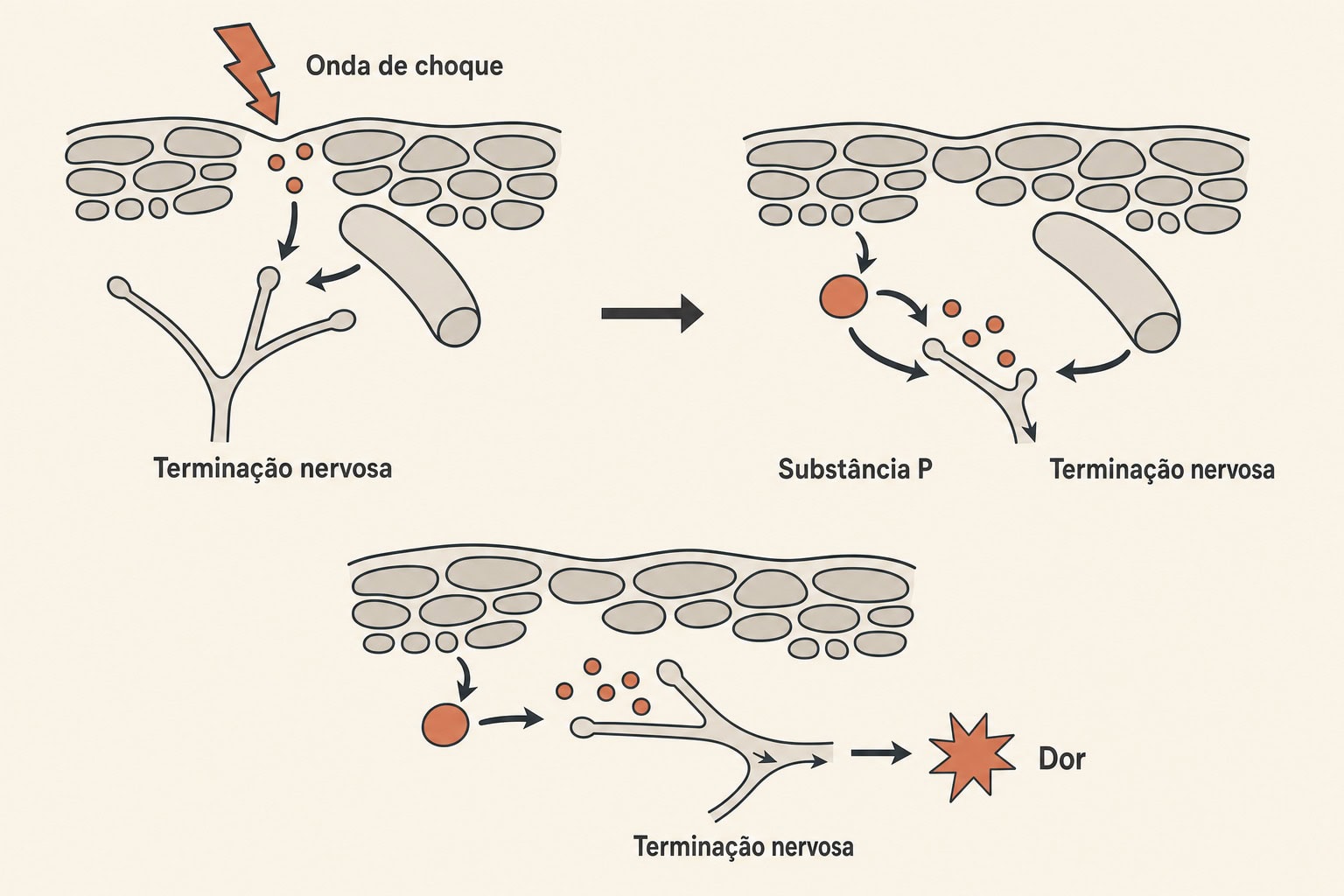 Diagrama em três etapas do efeito das ondas de choque sobre a substância P nas terminações nervosas