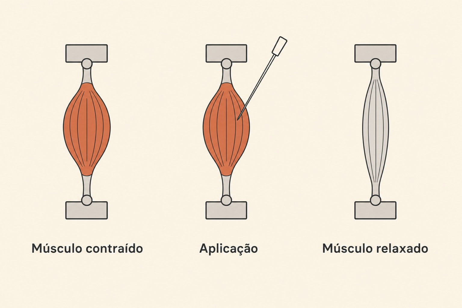 Sequência em três etapas mostrando o músculo contraído, a aplicação e o músculo relaxado